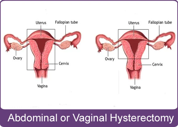 Abdominal or Vaginal Hysterectomy