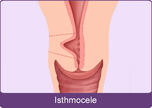 Isthmocele Treatment